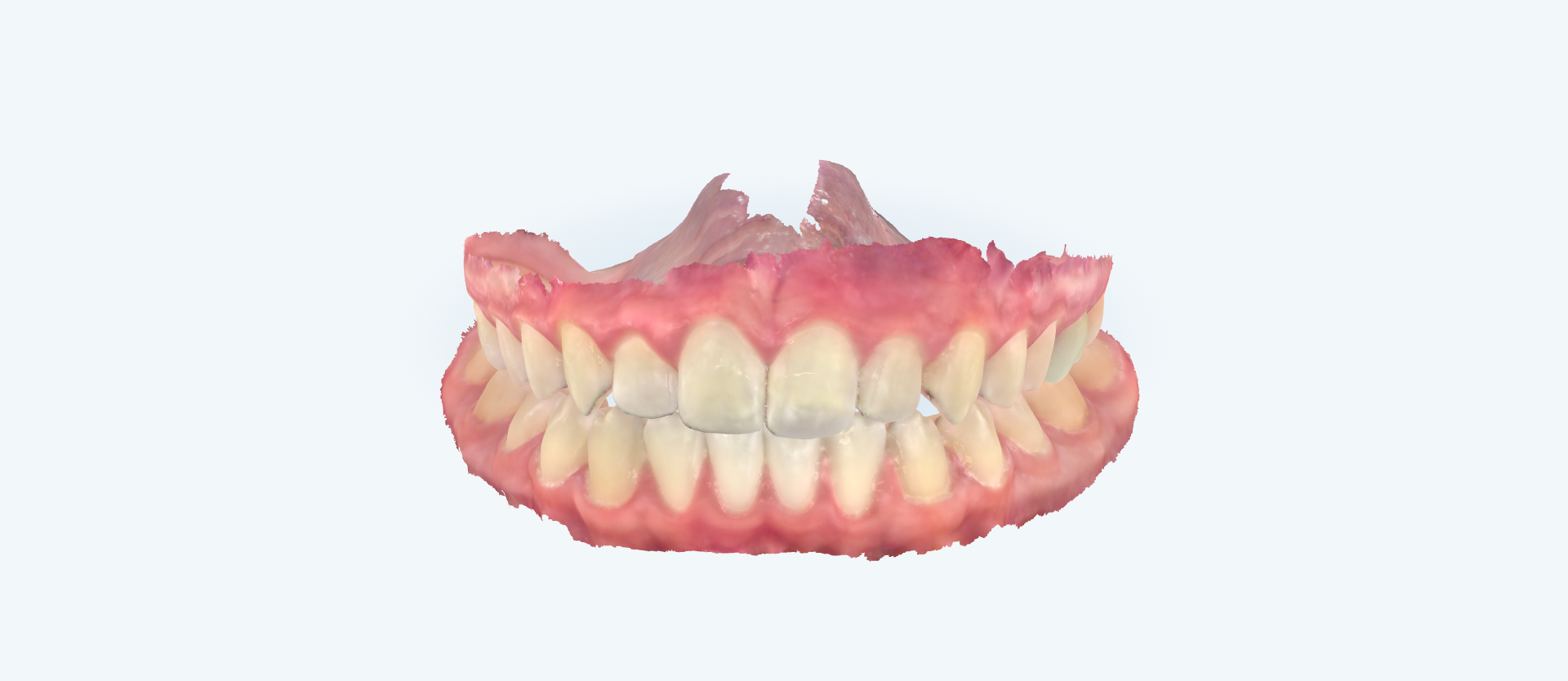 Openbite treatment comparison case 1 after